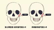 聯(lián)合麗格第 一醫(yī)院何照華院長(zhǎng)：張力帶固定顴骨內(nèi)推與傳統(tǒng)顴骨手術(shù)有何區(qū)別？