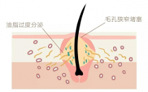 青春期臉上長(zhǎng)白色的小痘痘怎么辦？米迪豆專業(yè)祛痘值得信賴！